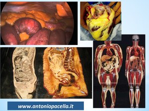 Pane, pizza e panettoni errori clinici e nutrizionali - Antonio Pacella Medico Specialista in Scienza dell'alimentazione